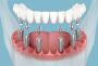 Smile Confidently Again with Custom Dental Implants