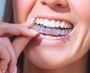 Affordable Invisalign Treatment Near Me - Straighten Your Te