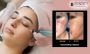 Microneedling Treatments for Scars in Bangalore - Dermaqure