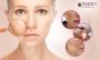 Best Laser Treatment for Pigmentation in Bangalore - Dermaqu