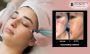 Best Microneedling Treatment for Scar in Bangalore