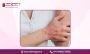 Effective Lichen Planus Treatment in Bangalore