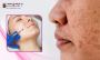 Best Open Pores Treatment in Bangalore