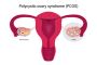How PCOS Symptoms Can Affect Your Skin and Hair