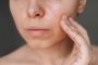 Why Sunscreen for Oily Skin is Essential for Your Skincare R