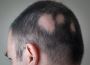 Can Alopecia Areata Be Treated Without Medications?