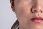 How to Identify Different Types of Pigmentation in Your Skin
