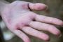 How to Manage Seborrheic Dermatitis Symptoms
