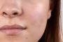What Causes Post-Inflammatory Hyperpigmentation?
