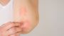 Stress and its Impact on Eczema Symptoms