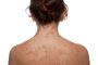 Causes of Eczema Symptoms in Adults