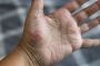 Tips to Prevent from Herpes Psoriasis  