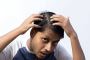 Insights from the Best Dermatologist for Alopecia Areata