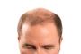 Current and Emerging Treatment for Androgenetic Alopecia