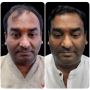 Unshaven hair transplant technique in India: Natural results