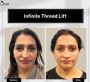 Facelift in India - Permanent Non-Surgical Scarless Facelift