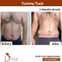 Male Tummy Tuck in India