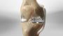Get Back on Your Feet with Partial Knee Replacement Surgery