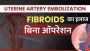 Get EffectiveUterineFibroidsTreatment from Dr.DharavKheradia