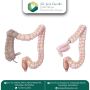 Safe & Trusted Hemicolectomy – Best Colon Cancer Treatment i