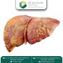Expert Surgeon for Best Liver Cancer Treatment in Ahmedabad,