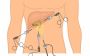 Expert Gall Bladder Surgery in Noida – Quick Recovery! 
