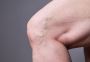 Looking for Experienced Doctors for Varicose Veins Near Me?
