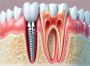 Best Invisalign Treatment in Vasant Kunj Delhi