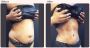 Beyond the Surface: The Deep Benefits of Tummy Tucks