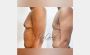 Will I Develop Loose Skin After Gynecomastia Surgery?