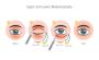 Procedure of Blepharoplasty Surgery in Delhi