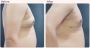 Choosing the Right Surgeon for Your Gynecomastia Procedure
