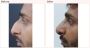 Nose surgery cost in Delhi - Dr Rajat Gupta
