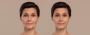 What to Expect When Getting a Facelift?