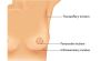 Choosing the Right Surgeon for Breast Augmentation