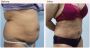 Liposuction Surgery Cost in delhi - Dr Rajat Gupta