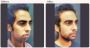 Chin implant surgery cost in Delhi - Dr Rajat Gupta