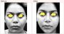 Buccal Pad Fat Removal Cost In Delhi - Dr Rajat Gupta