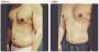 Fat removal surgery cost in Delhi - Dr Rajat Gupta