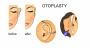 Otoplasty Surgery in Delhi - Dr Rajat Gupta