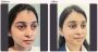 Does Blepharoplasty Remove Dark Circles?