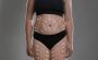 Can You Get a Brazilian Butt Lift with a Tummy Tuck?