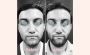 What Are Rhinoplasty Grafts and Why Are They Important?
