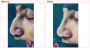 Rhinoplasty Surgery in Delhi - Dr Rajat Gupta