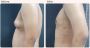 Gynecomastia Surgery Cost in Delhi - Dr Rajat Gupta