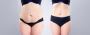 Tummy Tuck Surgery cost in Delhi - Dr Rajat Gupta