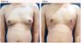 Gynecomastia Surgery Cost in Delhi - Dr Rajat Gupta