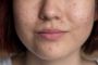 Healing the Skin, Restoring Confidence