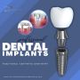 Dental implants Summerlin