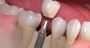 Get a Perfect Smile with Same-Day Crowns in Las Vegas!